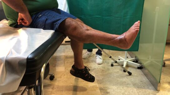 El doctor Cavadas opera una rodilla destrozada con una articulaci&oacute;n del propio tobillo del paciente