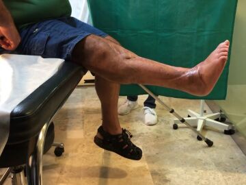 El doctor Cavadas opera una rodilla destrozada con una articulación del propio tobillo del paciente