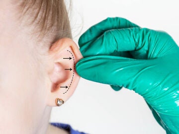 Una mujer con las orejas grandes se prepara para una otoplastia