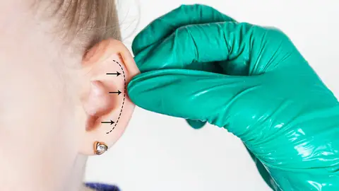 Una mujer con las orejas grandes se prepara para una otoplastia Una mujer con las orejas grandes se prepara para una otoplastia