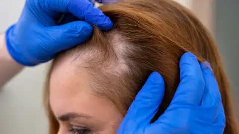 Revisión de la caída del cabello Revisión de la caída del cabello