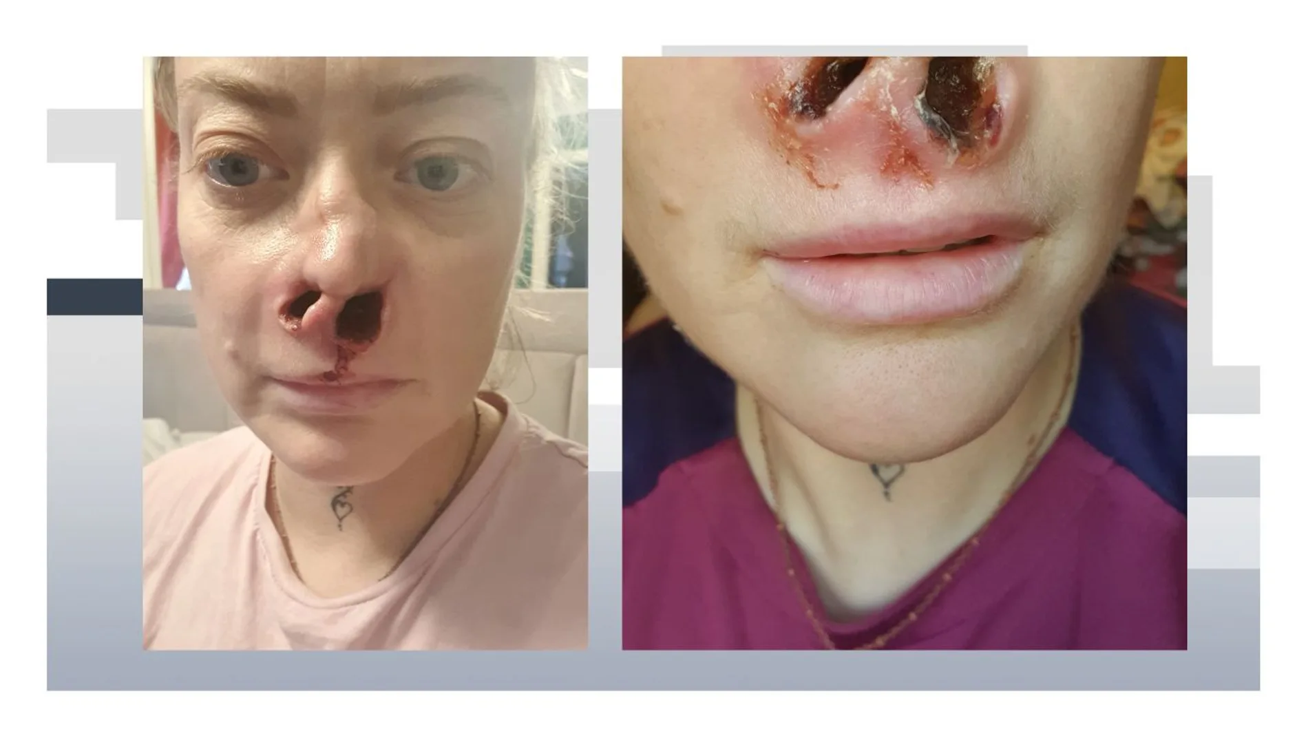Una mujer acaba con la nariz destrozada tras operarse la dentadura en Turquía: "Pegaba los dientes como si fuera un rompecabezas" Una mujer acaba con la nariz destrozada tras operarse la dentadura en Turquía: "Pegaba los dientes como si fuera un rompecabezas"