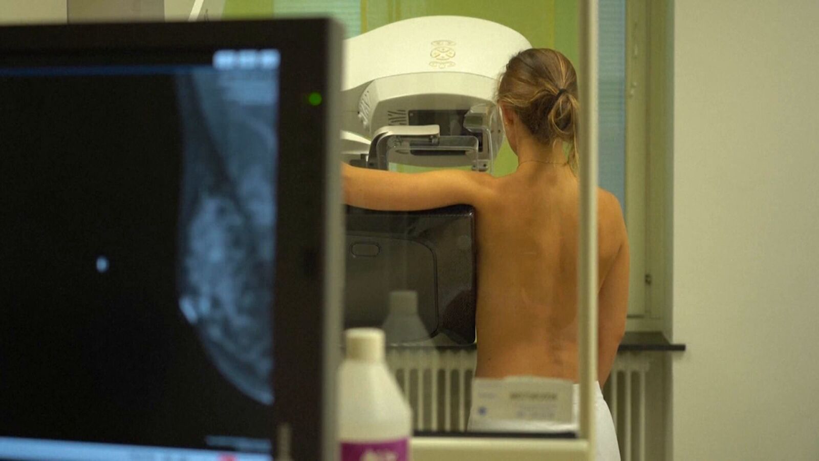 La Inteligencia Artificial predice el riesgo de cáncer de mama cuatro años antes 