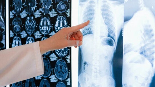 Radiograf&iacute;a de c&aacute;ncer de pulm&oacute;n 