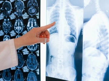 Radiografía de cáncer de pulmón 