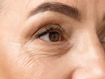 Patas de gallo Patas de gallo