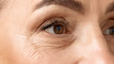 Patas de gallo Patas de gallo