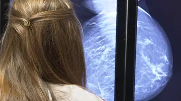 Diagnóstico cáncer de mama Diagnóstico cáncer de mama