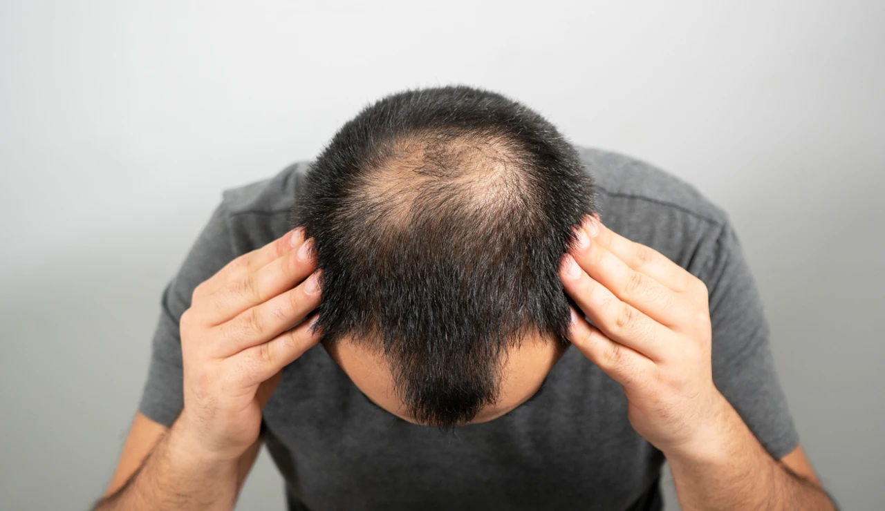 Problemas de alopecia