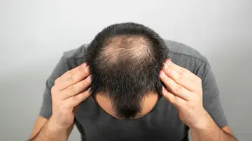 Problemas de alopecia Problemas de alopecia