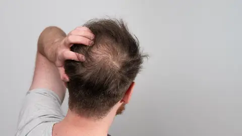 Hombre con problemas de calvicie Hombre con problemas de calvicie