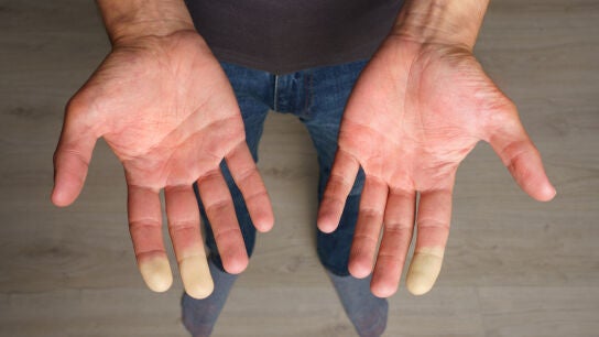 S&iacute;ndrome de Raynaud