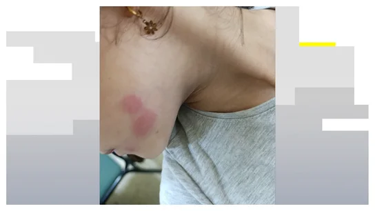 Una niña afectada Una niña afectada