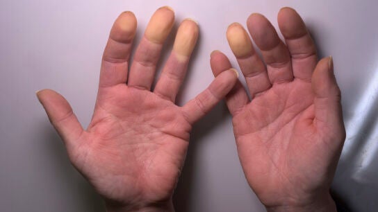 &iquest;Hipotermia o fr&iacute;o extremo?