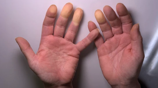 ¿Hipotermia o frío extremo? ¿Hipotermia o frío extremo?