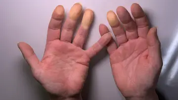 ¿Hipotermia o frío extremo? ¿Hipotermia o frío extremo?