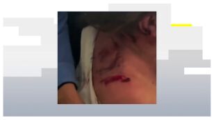 Las heridas en la espalda