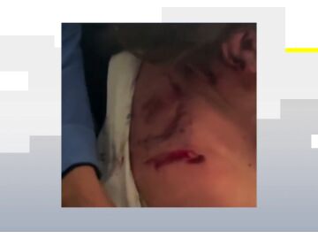 Las heridas en la espalda