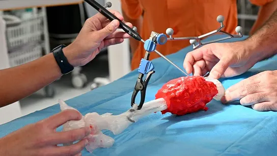 Salvan la pierna a un niño con un tumor óseo gracias a la tecnología 3D Salvan la pierna a un niño con un tumor óseo gracias a la tecnología 3D