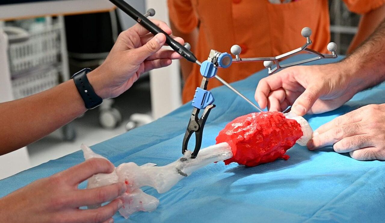 Salvan la pierna a un ni&ntilde;o con un tumor &oacute;seo gracias a la tecnolog&iacute;a 3D
