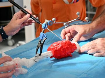 Salvan la pierna a un ni&ntilde;o con un tumor &oacute;seo gracias a la tecnolog&iacute;a 3D