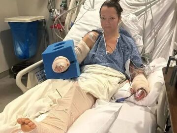 Una mujer pierde una pierna tras ser atacada por su propio pitbull 