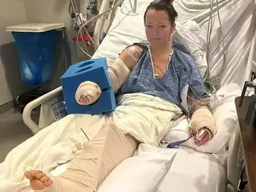 Una mujer pierde una pierna tras ser atacada por su propio pitbull Una mujer pierde una pierna tras ser atacada por su propio pitbull