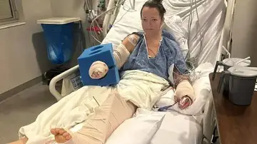 Una mujer pierde una pierna tras ser atacada por su propio pitbull Una mujer pierde una pierna tras ser atacada por su propio pitbull