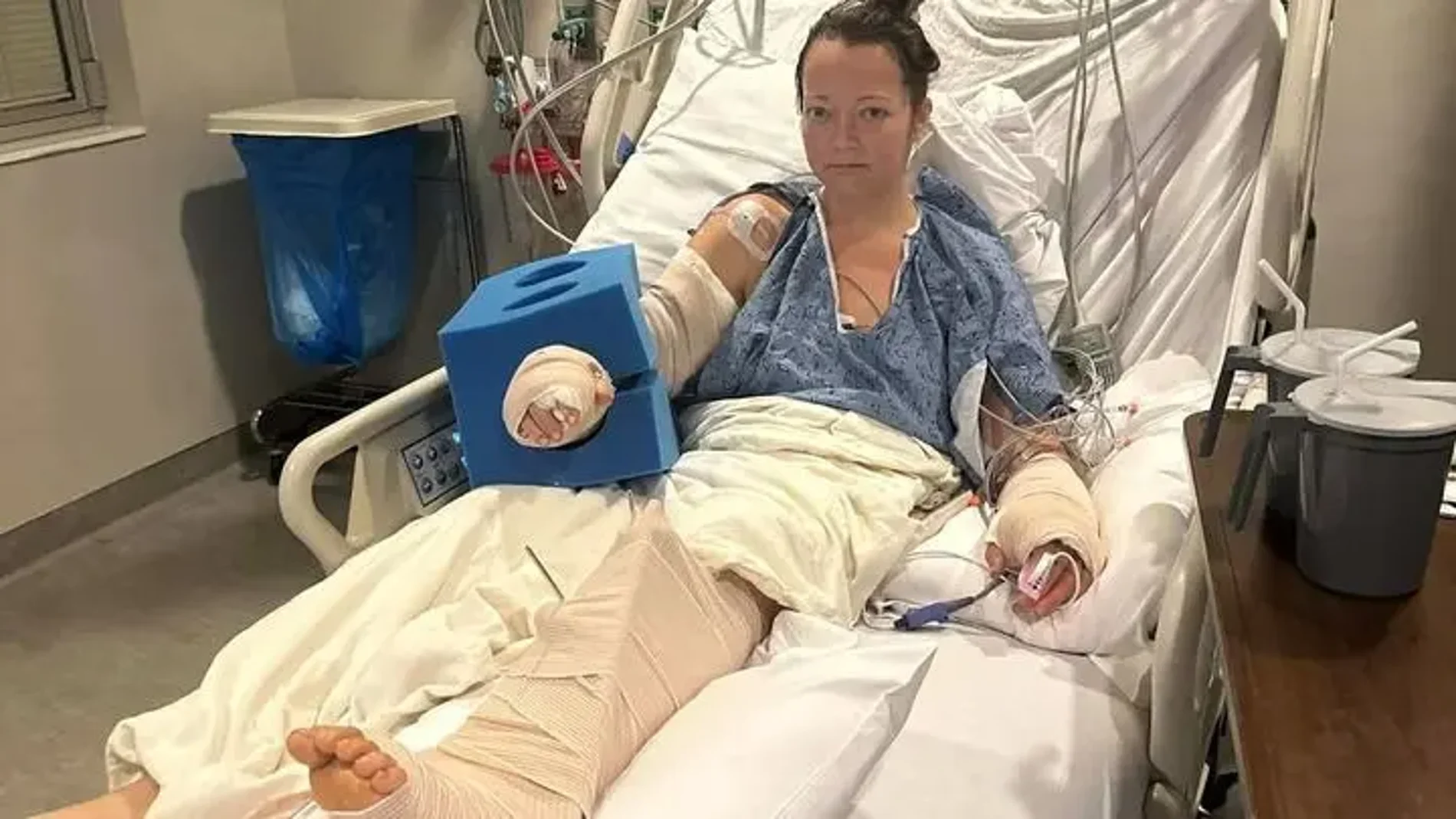 Una mujer pierde una pierna tras ser atacada por su propio pitbull Una mujer pierde una pierna tras ser atacada por su propio pitbull