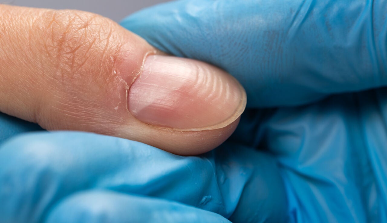 Surcos en las u&ntilde;as