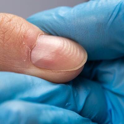 Surcos en las u&ntilde;as