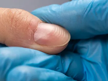 Surcos en las uñas Surcos en las uñas