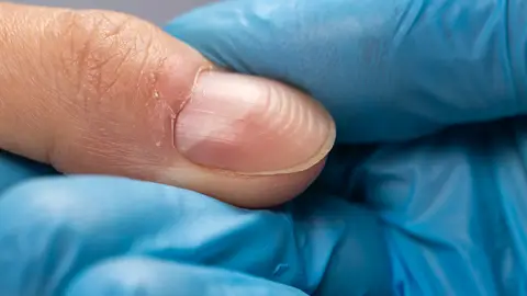 Surcos en las uñas Surcos en las uñas