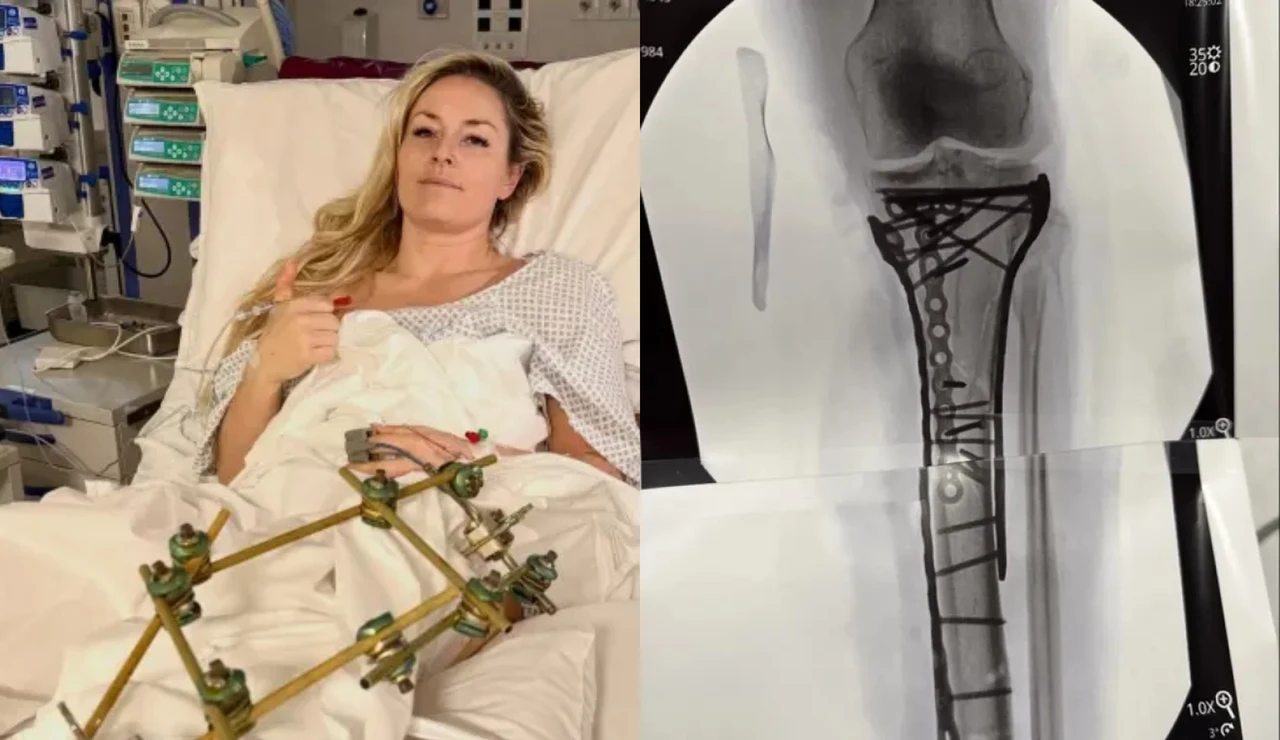 El calvario de Lindsey Vonn tras su caída en los Juegos