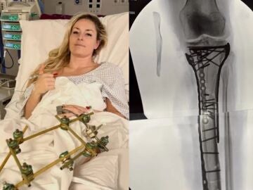 El calvario de Lindsey Vonn tras su ca&iacute;da en los Juegos