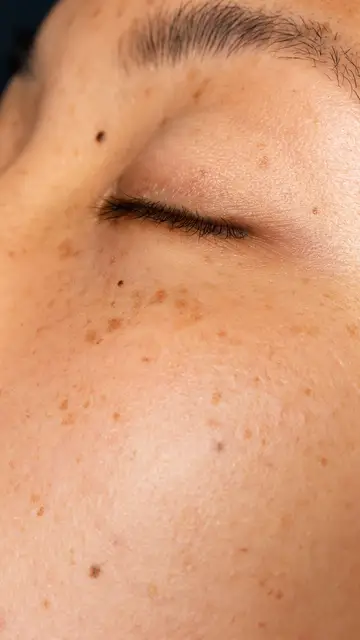 Mujer con manchas en la piel Mujer con manchas en la piel