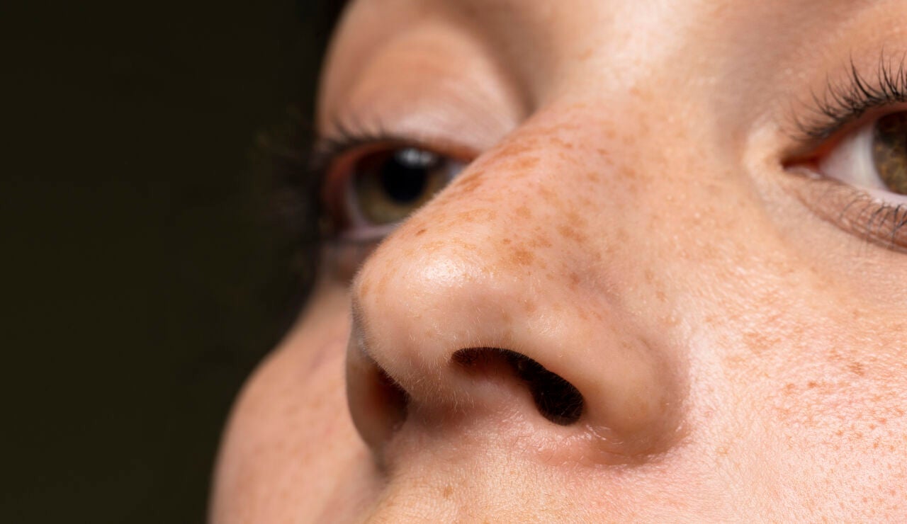 Mujer con manchas en la piel