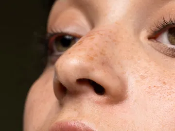 Mujer con manchas en la piel Mujer con manchas en la piel