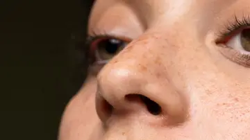 Mujer con manchas en la piel Mujer con manchas en la piel