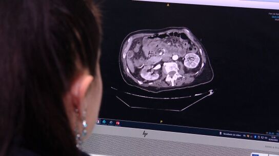 Infarto intestinal