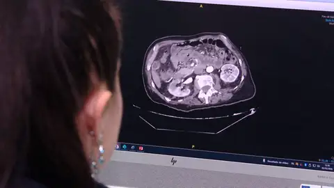 Infarto intestinal Infarto intestinal