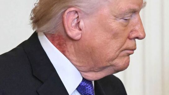 Mancha roja en el cuello de Donald Trump