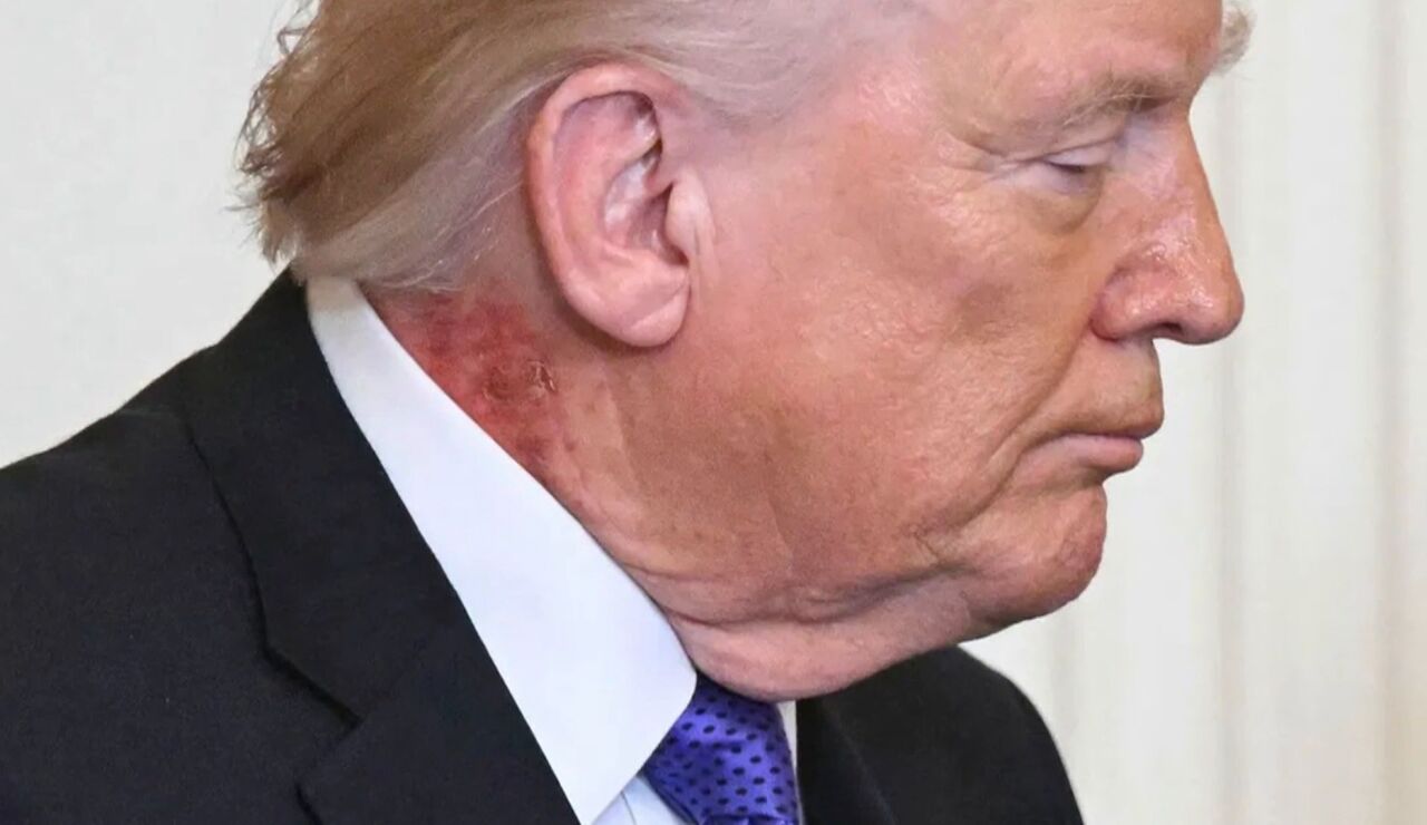 Mancha roja en el cuello de Donald Trump