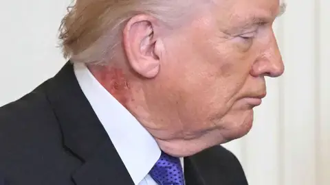 Mancha roja en el cuello de Donald Trump Mancha roja en el cuello de Donald Trump