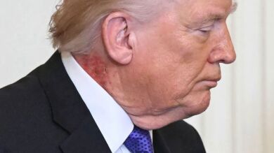 La mancha en el cuello de Donald Trump que ha hecho sonar todas las alarmas