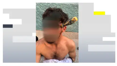 Duras imágenes: Le clavan a un joven de 25 años un destornillador en la cabeza Duras imágenes: Le clavan a un joven de 25 años un destornillador en la cabeza
