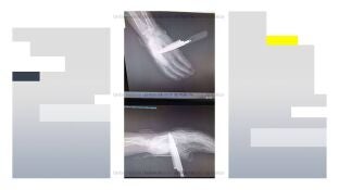 Radiograf&iacute;a de la mano del agente de la Polic&iacute;a Nacional apu&ntilde;alado en Baza (Granada)
