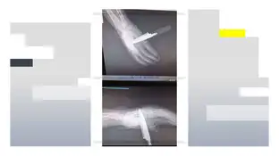 Radiografía de la mano del agente de la Policía Nacional apuñalado en Baza (Granada) Radiografía de la mano del agente de la Policía Nacional apuñalado en Baza (Granada)