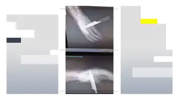 Radiografía de la mano del agente de la Policía Nacional apuñalado en Baza (Granada) Radiografía de la mano del agente de la Policía Nacional apuñalado en Baza (Granada)