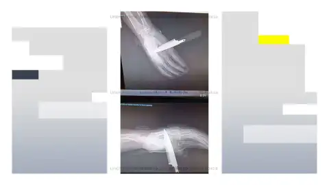 Radiografía de la mano del agente de la Policía Nacional apuñalado en Baza (Granada) Radiografía de la mano del agente de la Policía Nacional apuñalado en Baza (Granada)